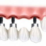 The Benefits of Dental Implants